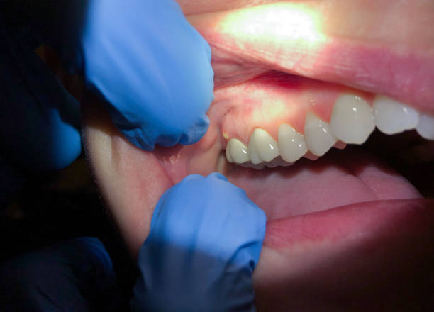 Best Emergency Dentist for Knocked-Out Tooth in Glasgow, DE
